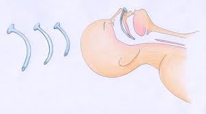 nasopharangeal airway