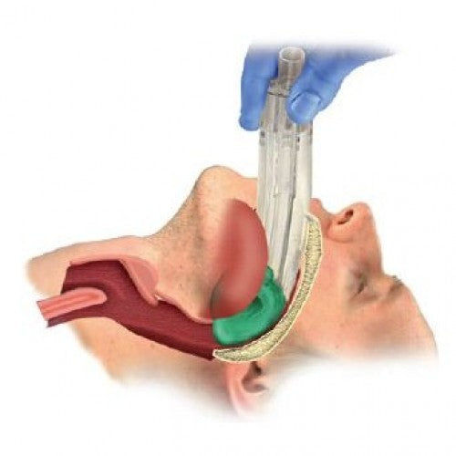 i-Gel Supraglottic Airway